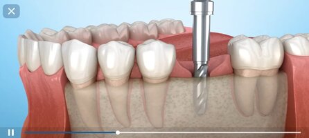 Screenshot_2026-08-16-07-04-45-880_com.alexmit.dentalillustrations.jpg