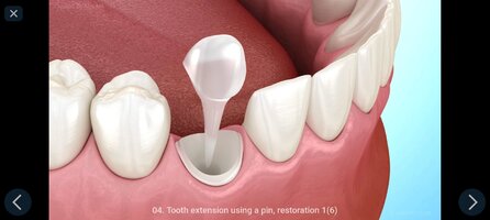 Screenshot_2026-08-16-07-04-22-052_com.alexmit.dentalillustrations.jpg